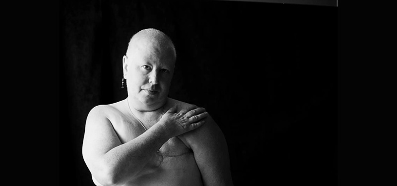 photo of a woman posing with a surgical scar